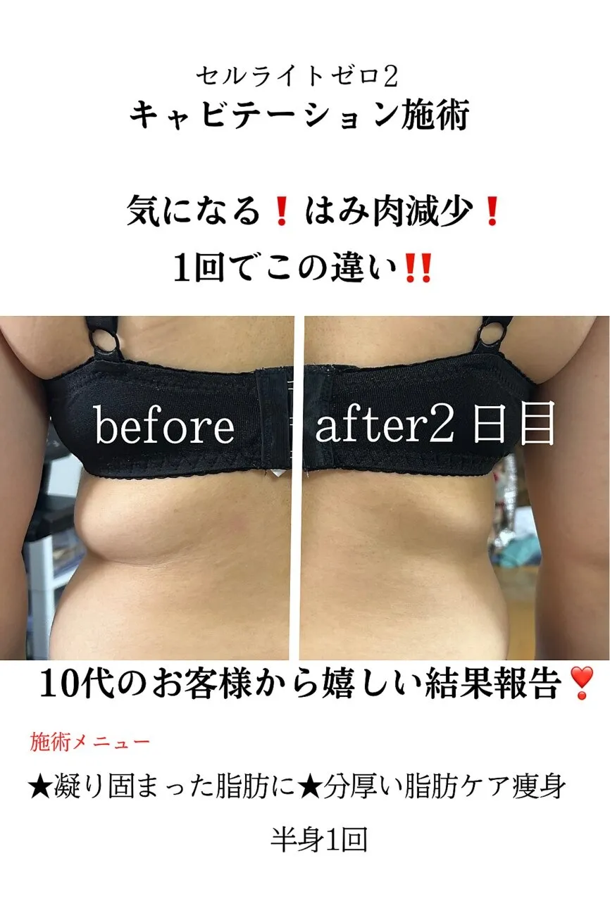  キャビテーション1回